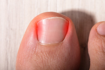 Why Are My Toenails Ingrown?