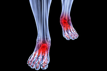 Arthritic foot and ankle care treatment, foot arthritis treatment in the Pearland, TX 77584 and Houston, TX 77027, 77074, 77008 areas