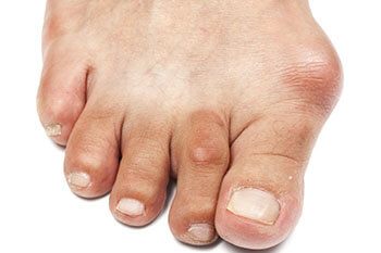 Bunions treatment in the Pearland, TX 77584 and Houston, TX 77027, 77074, 77008 areas