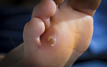Corns and Calluses treatment in the Pearland, TX 77584 and Houston, TX 77027, 77074, 77008 areas