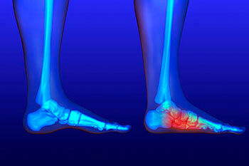 Flat feet and Fallen Arches treatment, Flatfoot Deformity Treatment in the Pearland, TX 77584 and Houston, TX 77027, 77074, 77008 areas