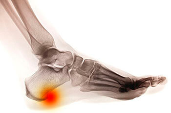 Heel spurs treatment in the Pearland, TX 77584 and Houston, TX 77027, 77074, 77008 areas