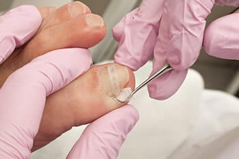 Ingrown toenails treatment in the Houston, TX 77027, 77074, 77008 and Pearland, TX 77584 area