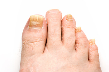 Fungal toenails diagnosis and treatment in the Pearland, TX 77584 and Houston, TX 77027, 77074, 77008 areas