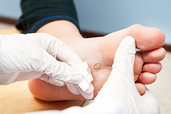 Plantar warts treatment in the Pearland, TX 77584 and Houston, TX 77027, 77074, 77008 areas