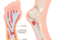 How Athlete’s Can Safeguard Against Plantar Fasciitis
