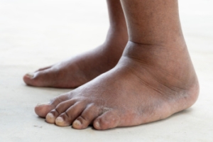 Conditions That May Cause Swollen Feet