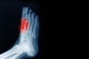 What Can Cause Sesamoiditis?