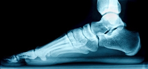 The Dynamics of Adult Acquired Flat Feet