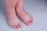 Foods That May Lead To Swollen Feet
