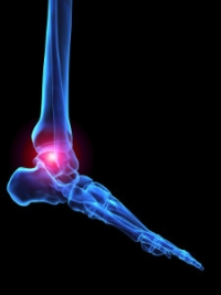 Symptoms of Rheumatoid Arthritis in the Lower Limbs