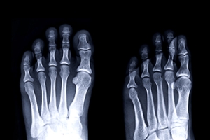 Recovery Time for a Stress Fracture to Heal