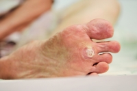 Treating and Preventing Plantar Warts